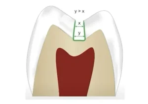 Why dentists don't drill like they used to