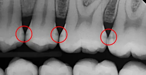 Why dentists don't drill like they used to